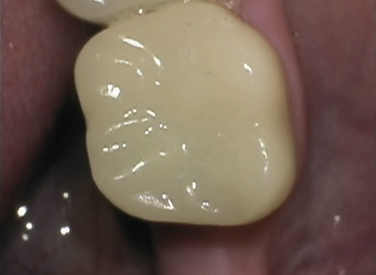 After treatment: the same tooth restored with a natural-looking crown